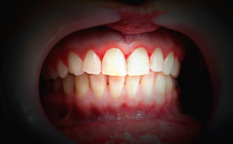 Persons mouth open to expose bleeding gums around white teeth
